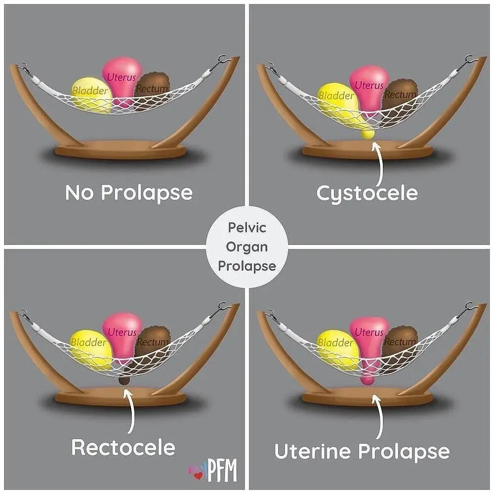 Cystocele bladder prolapse medical diagram showing anatomical changes